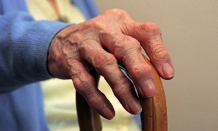 Artrite e artrose dos dedos nunha persoa anciá
