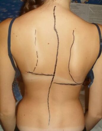 Hump de costela