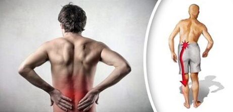 A síndrome da dor coa osteocondrose lumbar irradia ás pernas