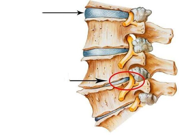 disco normal e danado na columna vertebral