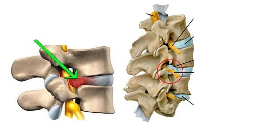 dor lumbar debido á hernia discal
