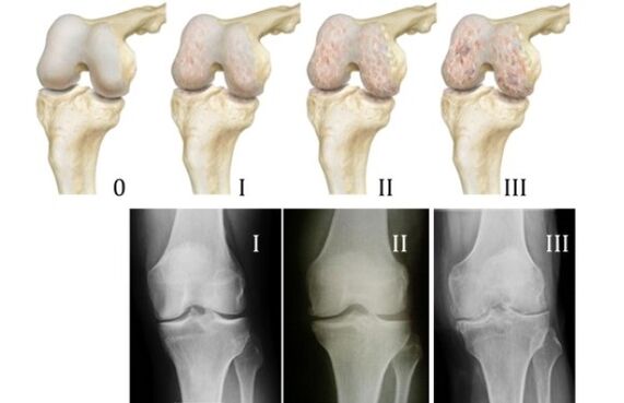 Métodos para diagnosticar a artrose do xeonllo